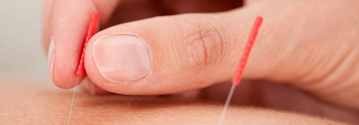 Chiropractic Parker CO Dry Needling